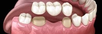 Dental bridges diagram | Glen Waverley Dentist