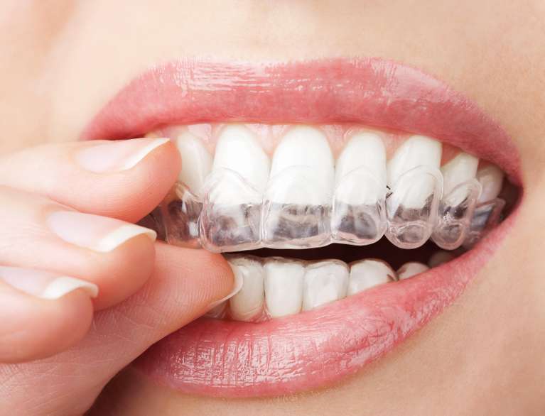 A person smiling, showcasing the clear Invisalign braces on her teeth.
