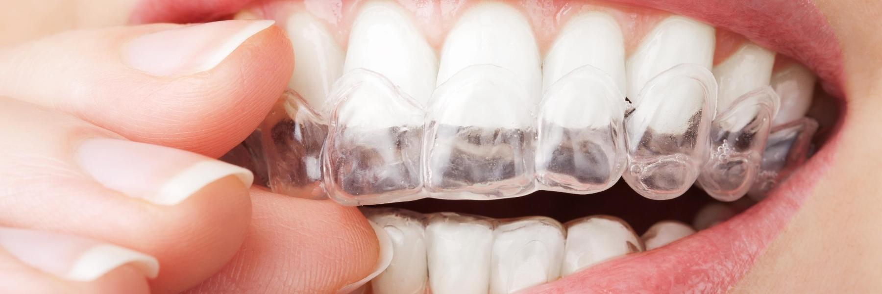 woman putting in invisalign in mount wavelry