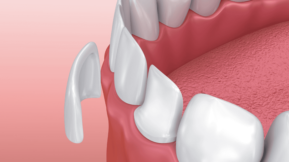 Veneers Benefits, Procedure and Results Cosmetic Dentistry Mount