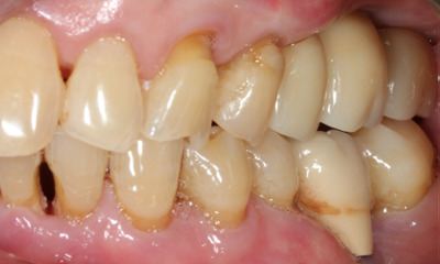 After photo of three dental implants restoring chewing ability at Mount Waverley Smiles