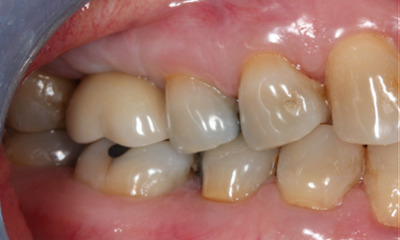 After photo of completed dental implant restoring chewing function by Dr Austin Rhee