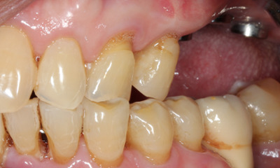 Before photo of missing teeth caused by severe gum disease