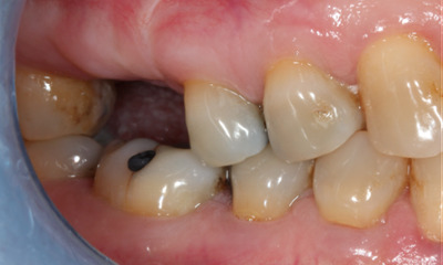Before photo of missing tooth prior to dental implant at Mount Waverley Smiles